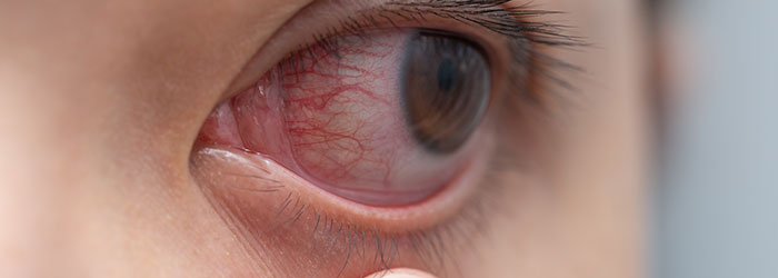 Pourquoi a-t-on les yeux rouges avec le CBD ?